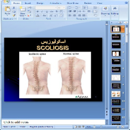 دانلود پاورپوینت کج پشتی یا Scoliosis- در 59 اسلاید