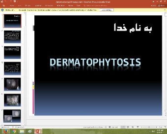 پاورپوینت درباره درماتوفیتوزیس (Dermatophytosis)