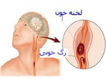 تحقیق سکته مغزی