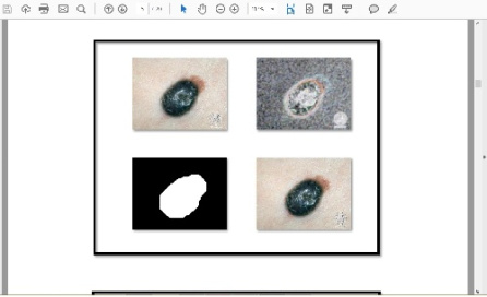 پروژه کد نویسی درس پردازش تصویر در متلب(matlab) تشخیص ملانوما توسط ویژگی های مبتنی بر هندسه ی سرطان پوست (با استفاده از پارامترهای ABCD)