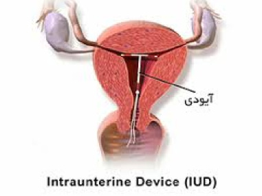 تحقیق  IUD