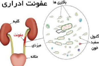 عفونت‌هاي دستگاه ادراري و پيلونفريت