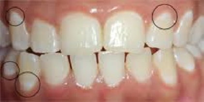 پاورپوینت در مورد پوسیدگی دندان و روشهای مراقبت از دندان و جلوگیری از عفونت و خرابی دندان