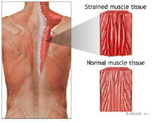 پاورپوینت کامل و جامع با عنوان آسیب های وارده به سیستم عضلانی - وتری در تربیت بدنی در 69 اسلاید