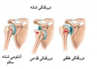 پاورپوینت کامل و جامع با عنوان آشنایی با دررفتگی و انواع آن در تربیت بدنی در 42 اسلاید