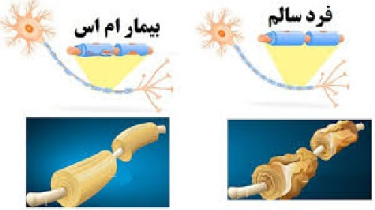 تحقیق بیماری ام اس و علائم آن