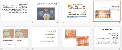 پاورپوينت رشته هاي دندان پزشکی با عنوان پوسیدگی دندان