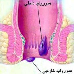 دانلود پاورپوینت هموروئید(بواسیر)