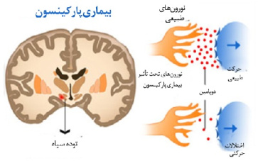 پاورپوینت کامل و جامع با عنوان بیماری پارکینسون (Parkinson) و روش های تشخیص و درمان در 60 اسلاید