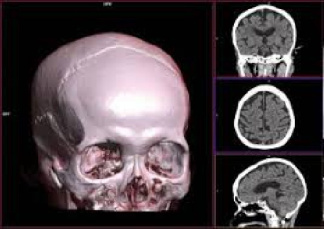 تفسیر اورژانسی brain ct scan(مغز)