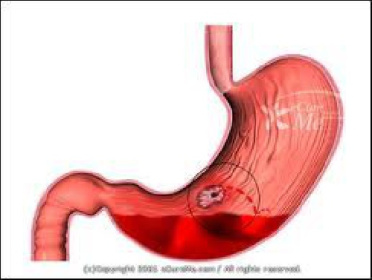 کنفرانس آماده دانشجویی خونریزی گوارشی(GI Bleeding)