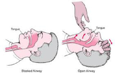 Air way management(باز کردن راه هوایی)