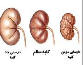 پاورپوینت نارسایی حاد کلیه