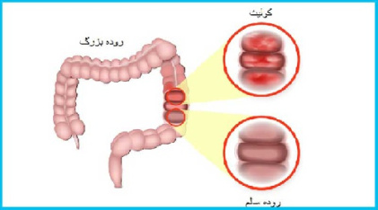 درمان کولیت روده