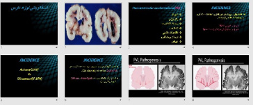 پاورپوینت با عنوان انسفالوپاتی نوزاد نارس