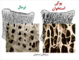 پاورپوينت با عنوان پوکی استخوان