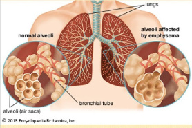 پاورپوينت با عنوان بیماریهای تنفس  COPD – ARF – ARDS