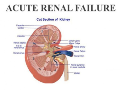 پاورپوینت ارائه بیماری نارسایی حاد کلیه (acute renal failure) و سنگ های کلیوی
