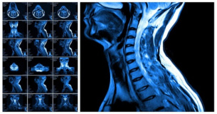 پاورپوینت آماده در مورد روش تصویربرداری MRI از فقرات