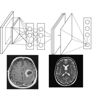 شناسایی تومور در تصاویر MRI مغز به کمک شبکه‌‌ی کانولوشنی عمیق (پایتون)