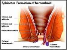 هموروئید یا بواسیر چیست؟
