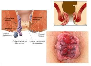 پاورپوینت هموروئید (بواسیر)