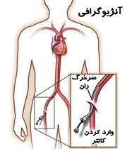 پاورپوینت آنژیوگرافی