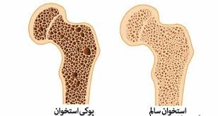 پاورپوینت استئوپروز یا پوکی استخوان