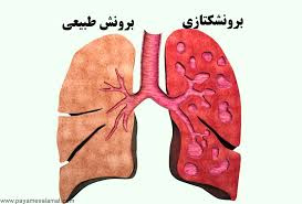 پاورپوینت درباره بیماری آسم