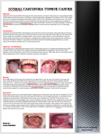 پوستر Poster Presentaton About Scomas Carcinoma Tongue Cancer