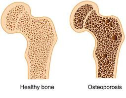 پاورپوینت استئوپروزیس