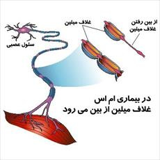 تحقیق بیماری MS