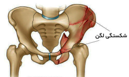 پاورپوینت شکستگی لگن