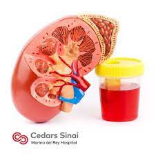 پاورپوینت خون در ادرار Hematuria