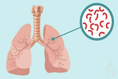 پاورپوینت  آنچه شما باید در مورد سل (TB) بدانید