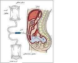 پاورپوینت دیالیز صفاقی