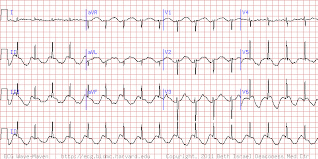 پاورپوینت تشخیص آریتمی های بطنی با استفاده از سیگنال ECG