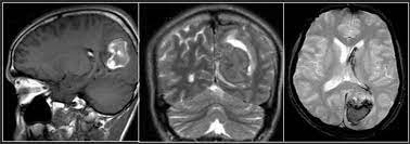 پاورپوینت ارزیابی خون ریزی های مغزی در MRI