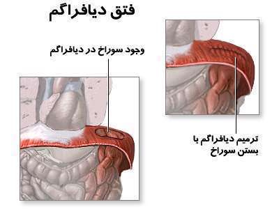 پاورپوینت دیافراگماتیک فتق