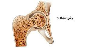 پاورپوینت پوکی استخوان و درمان آن