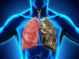 پاورپوینت بيماريهاي شغلي ريه Occupational Lung Disease