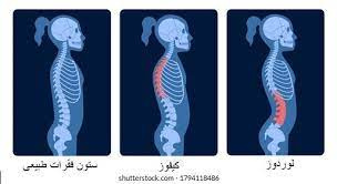 پاورپوینت ایمنی ستون مهره های کمر