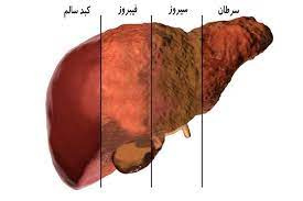 پاورپوینت کبد چرب