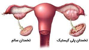 پاورپوینت تخمدان های پلی کیستیک و عدم تخمک گذاری مزمن هیپرآندشروژنیک