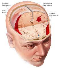 پاورپوینت Acute Traumatic Head Injuries صدمات حاد تروماتیک سر