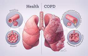 پاورپوینت بیماری های مزمن انسدادی ریه COPD