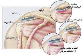 پاورپوینت آسیب های شانه