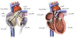 پاورپوینت قلب مصنوعي و دستگاه كمكي بطن