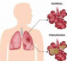 پاورپوینت پنومنی penumonia