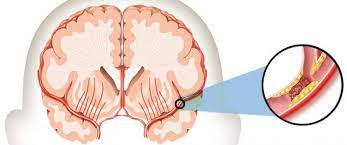 تحقیق مقايسه تست سمپاتيك پوستي افراد دچار حادثه عروقي ايسكميك مغز با افراد سالم